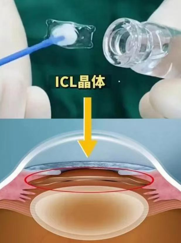 ICL晶体植入