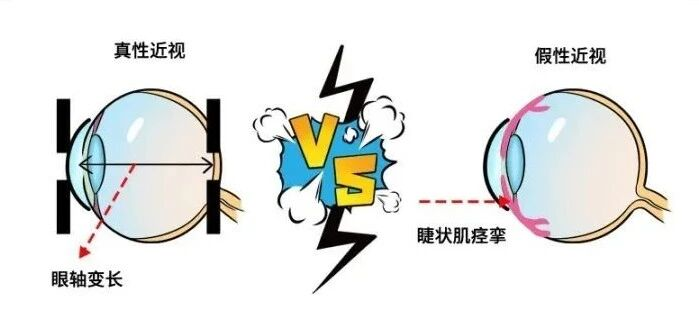 警惕假性近视：近视防控的“黄金窗口期”