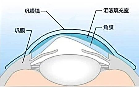 圆锥角膜、重度干眼视力难矫正？巩膜镜“点亮”新方案